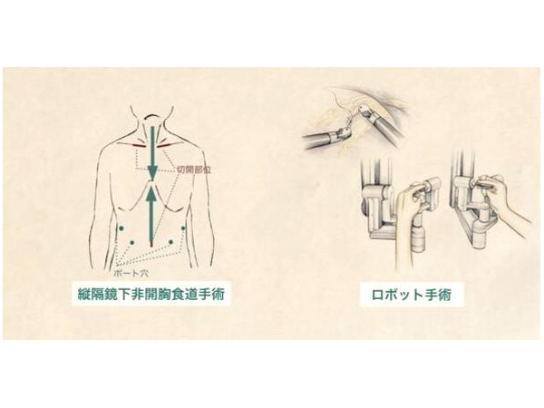 日本食道癌纵膈镜手术的特征以及优点