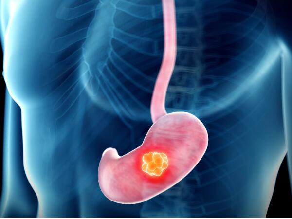 日本医疗：胃癌细胞繁殖原理被识破，新疗法有望出炉