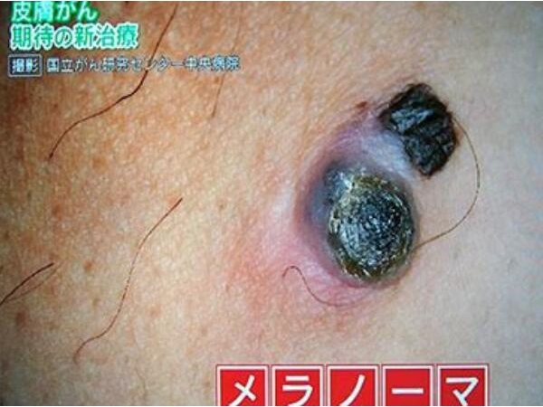 去日本看病又有福音了：恶性黑色素瘤的克星被研制出来