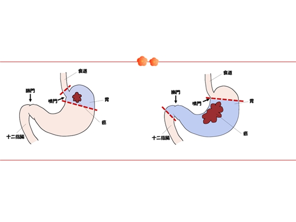 日本的胃癌治疗到底有多强？看完这篇文章你就知道了