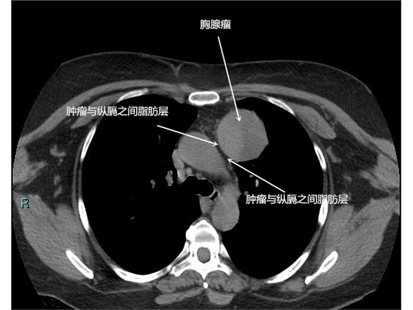 稀少癌症——胸腺癌和胸腺瘤