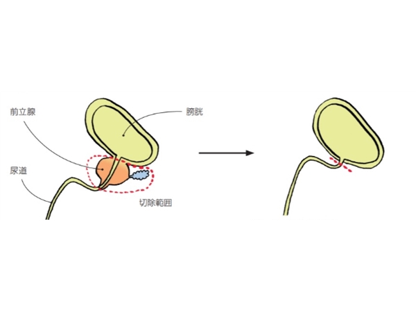 海外癌症医疗信息参考——前列腺癌