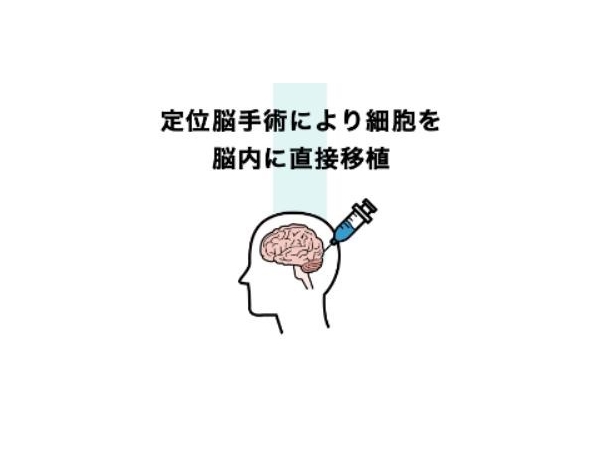 里程碑！全球首款慢性脑损伤干细胞药 SB623 在日本获批，为瘫痪患者带来新希望