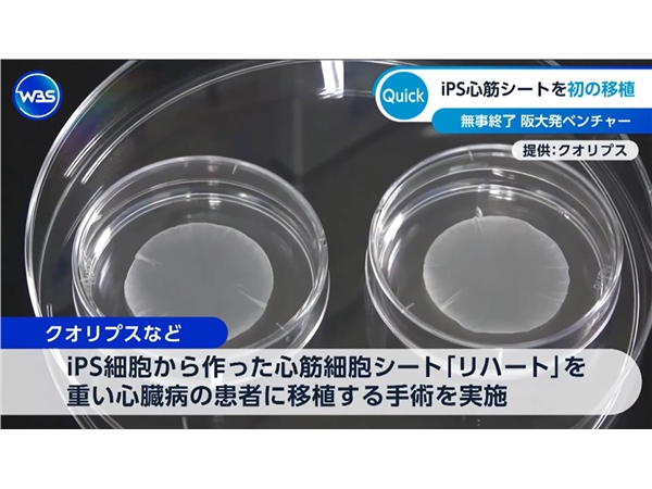 日本完成世界首例 iPS 心肌细胞贴片移植手术，重症心衰迎来新希望