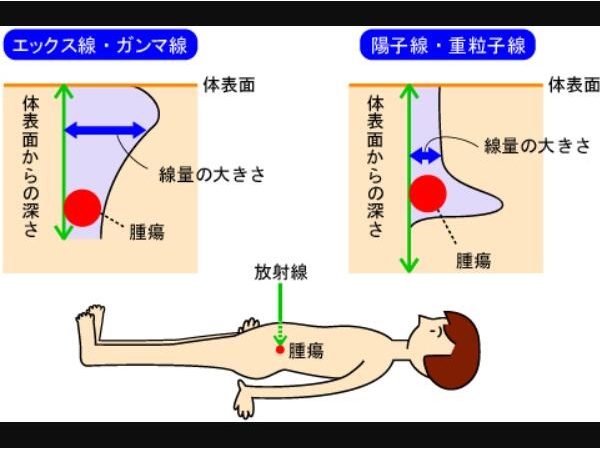 质子治疗肿瘤技术