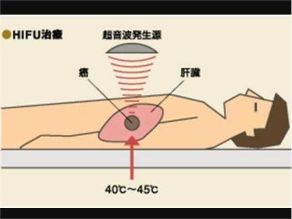 癌症的聚焦超声技术疗法（HIFU）